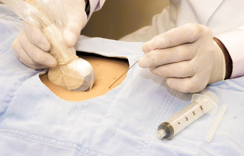 Prenatal FISH diagnostikasi