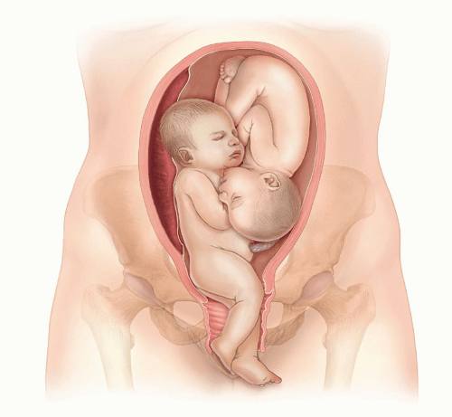 1-tug‘ruq bo‘limida egizaklarning murakkab tug‘ruqlari muvaffaqiyatli qabul qilindi.