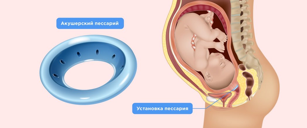 Akusherlik pessariy